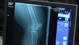 W wyniku pandemii tysiące chorych na osteoporozę pozostają bez pomocy. Lekarze i pacjenci apelują o proste zmiany umożliwiające diagnostykę i leczenie [DEPESZA] News powiązane z złamanie osteoporotyczne
