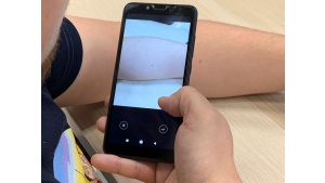 Aplikacja SkinCareAI pomoże w diagnozie czerniaka Biuro prasowe